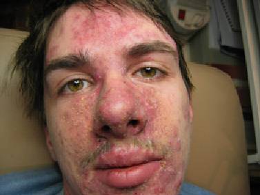 Acne before treatment