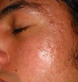 Acne after Yachroma-Med copper vapor laser treatment 