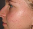 Acne after laser treatment