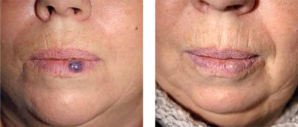 Venous Lake before-after one treatment