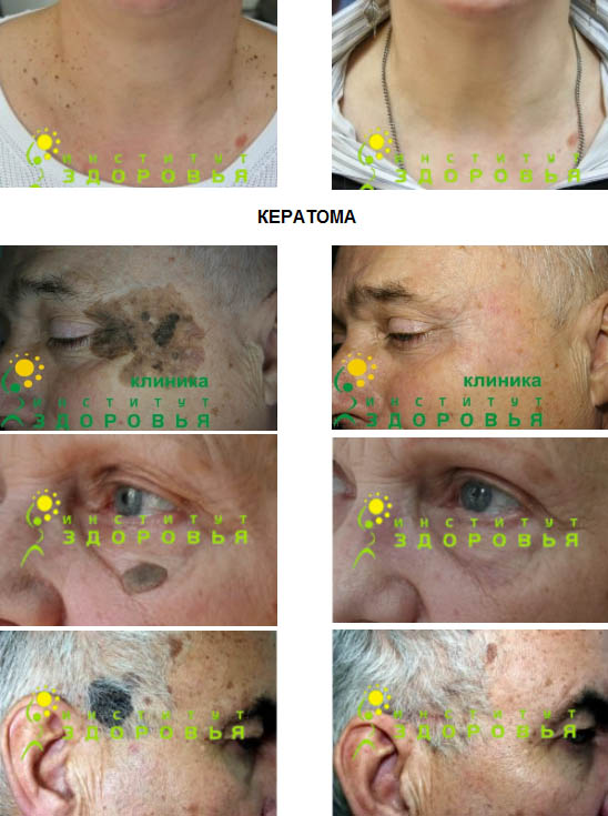 seborrheic keratosis