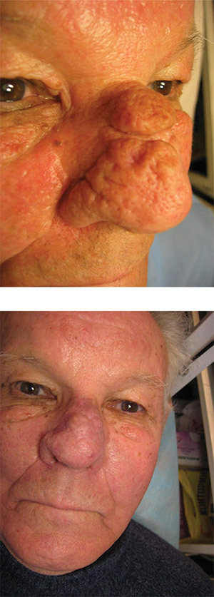 Patient With Rhinophyma before-after3 Session of Copper Vapor Laser
