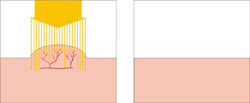 Схема воздействия желтого лазера 578 нм на неокрашенные новообразования кожи