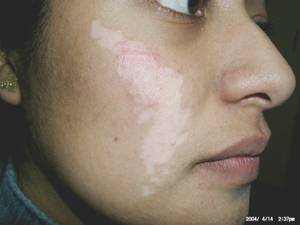 Vitiligo before treatment