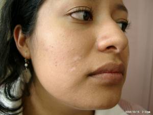 Vitiligo after 4 treatment