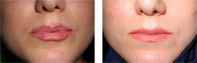 Лечения лазерным аппаратом "Яхрома-мед"гранулемы красной каймы губ после татуажа губ